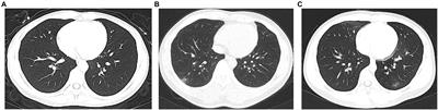 Clinical Characteristics of Omicron SARS-CoV-2 Variant Infection After Non-mRNA-Based Vaccination in China